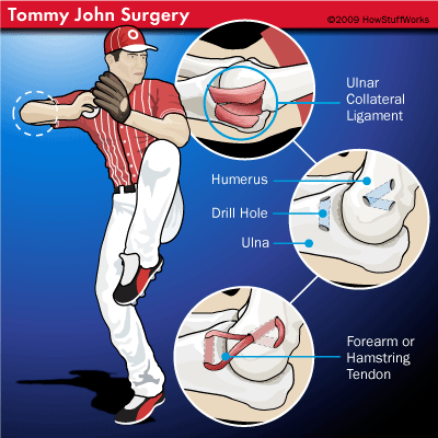 surgery-baseball-4